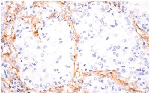May – Integrin beta-5 (F9C2U) Rabbit -8 Immunohistochemical staining of tissue showing brown-stained tubule structures and blue nuclei on a pale background.
